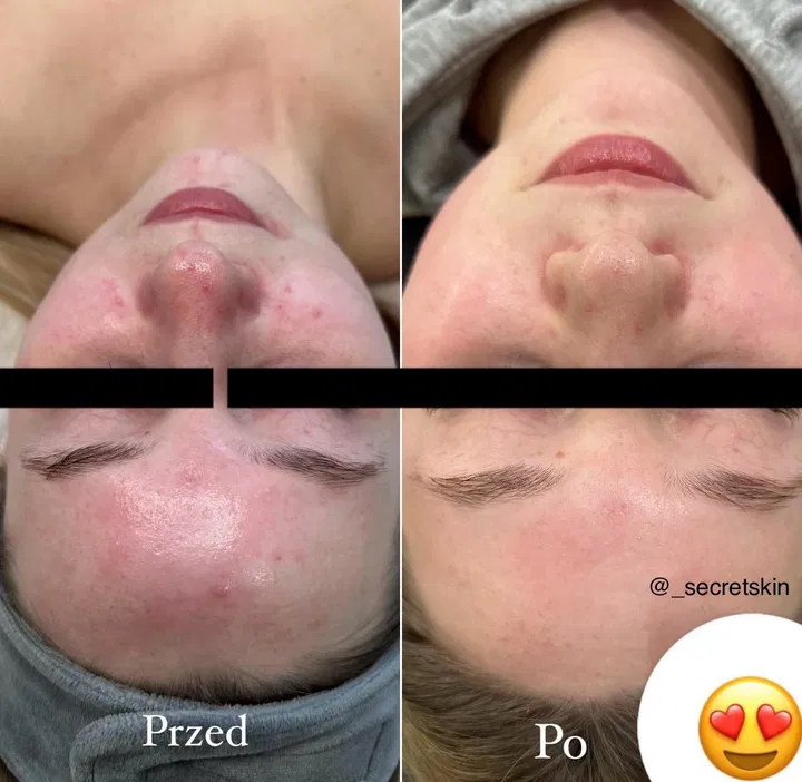 Efekty oczyszczania skóry twarzy przed i po zabiegu - porównanie cery z problemami trądzikowymi, zabieg pielęgnacyjny na skórę, poprawa wyglądu i kondycji skóry