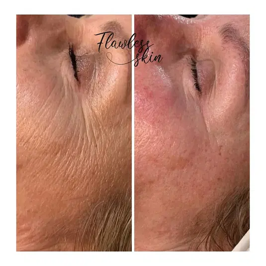  Porównanie skóry przed i po zabiegu kosmetycznym, efekt wygładzenia zmarszczek, poprawa wyglądu cery, zabieg anti-aging. 