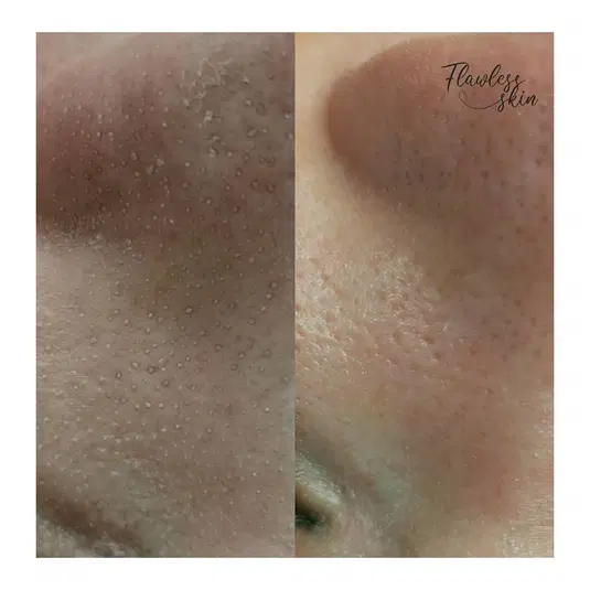  Przed i po zabiegu pielęgnacji skóry twarzy – redukcja porów, poprawa tekstury, Flawless Skin. 