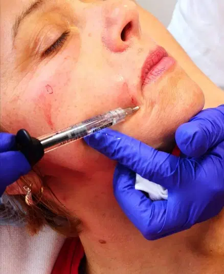 Zabieg medycyny estetycznej, wypełnianie zmarszczek, kobieta, iniekcja kwasem hialuronowym, rękawiczki ochronne, dermatologia estetyczna. 